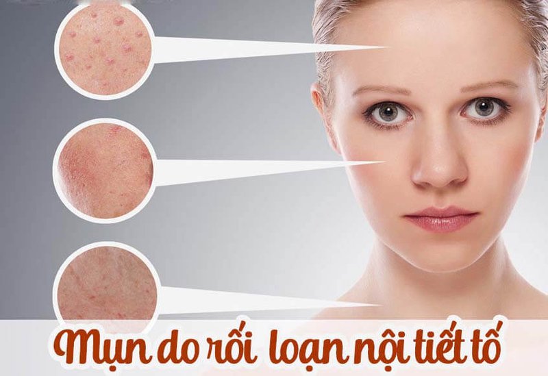 (Mới) Trị Mụn Nội Tiết Cho Người Mới Trưởng Thành